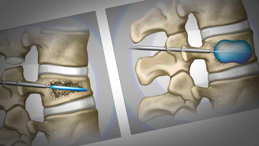compression fracture treatment kyphoplasty