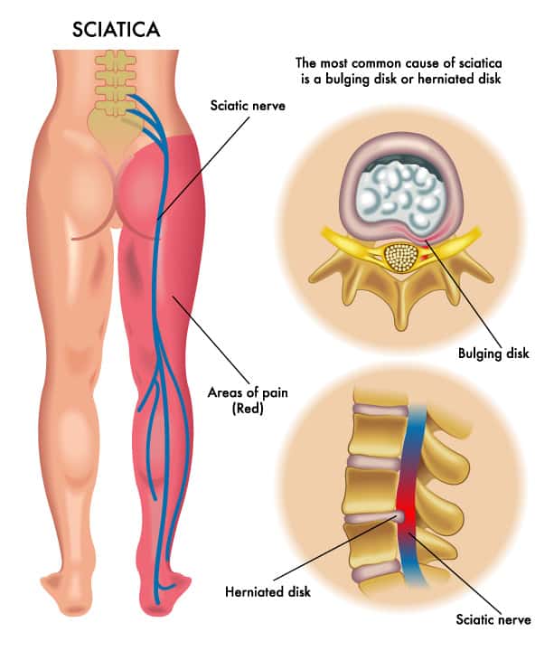 What Does Greater Sciatic Notch Mean In Medical Terms