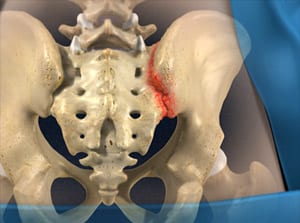 What hurts in my tailbone - SI joint pain