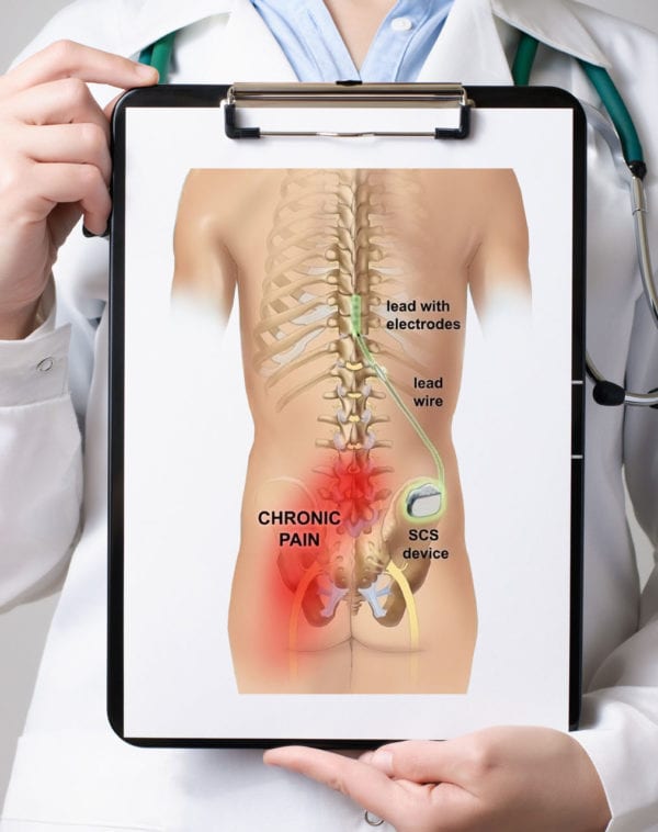 spinal-cord-stimulation-spine-one-denver-spine-pain-specialists