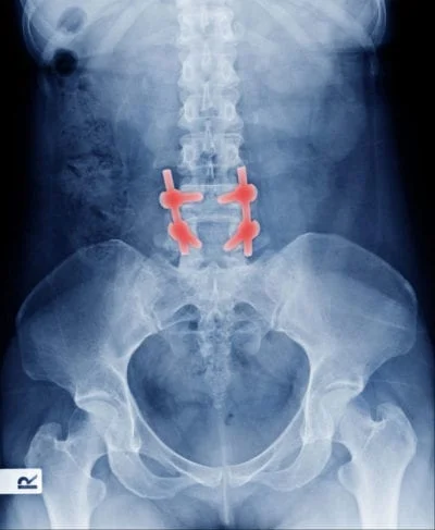 X-ray image of spine surgery hardware