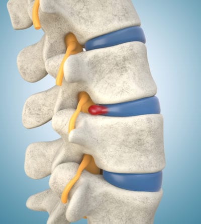 Slipped Disc Treatment at Spine One | Denver Spine Pain Specialists