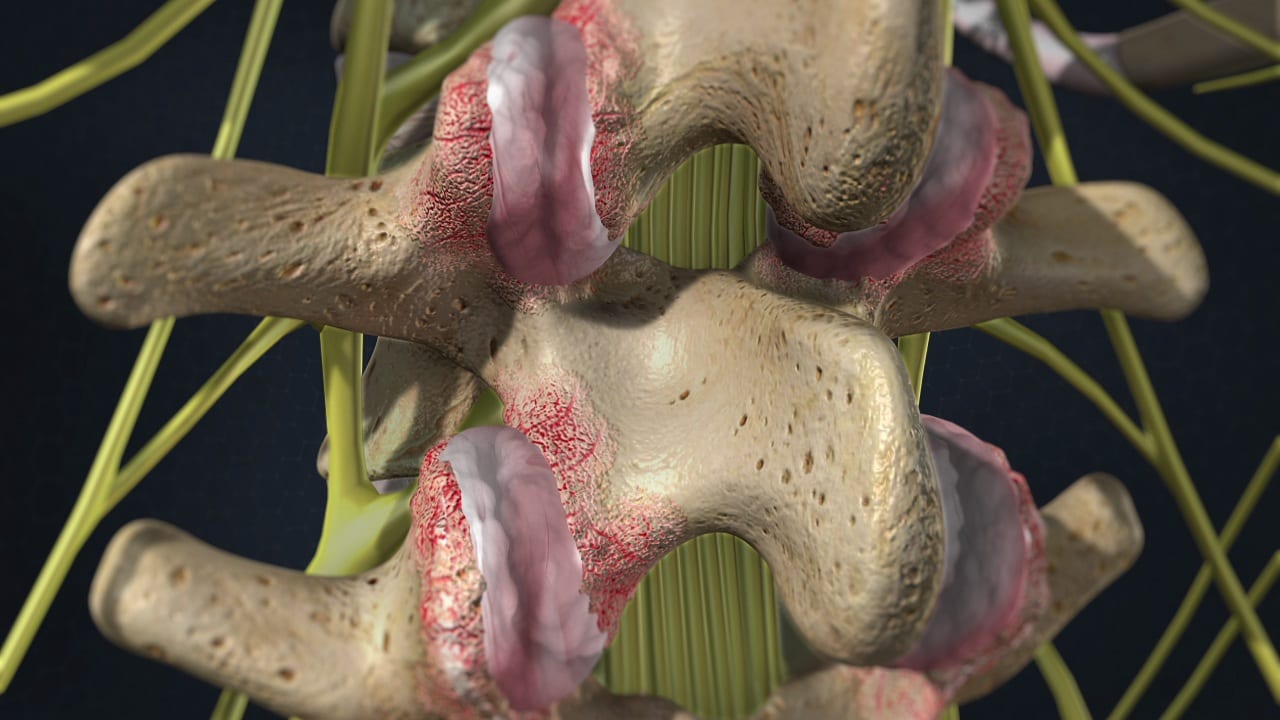 What Is Facet Arthropathy