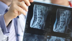 Doctors holds spine X-ray images