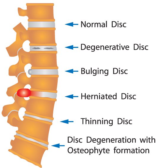 Discogenic Pain Diagram