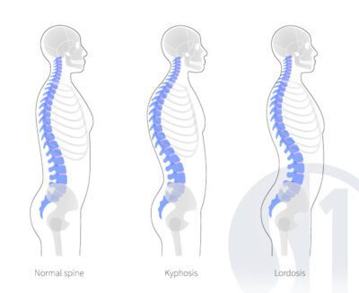 Kyphosis Treatment at Spine One | Denver Spine Pain Specialists