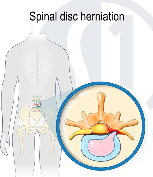 spinal disc protrusion doctor