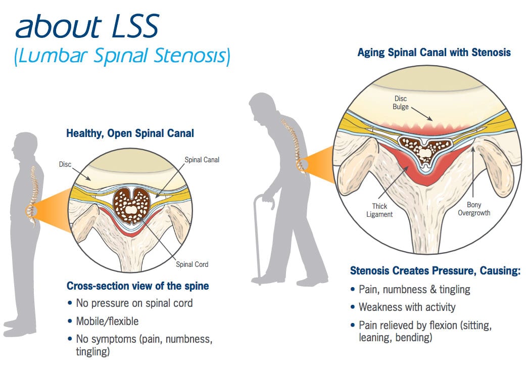 Denver Spine Specialist for Lumbar Spinal Stenosis