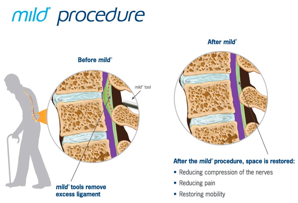 Denver Spine Specialist MILD procedure