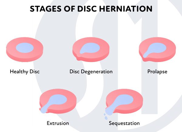 Diagram of a Prolapsed Disc