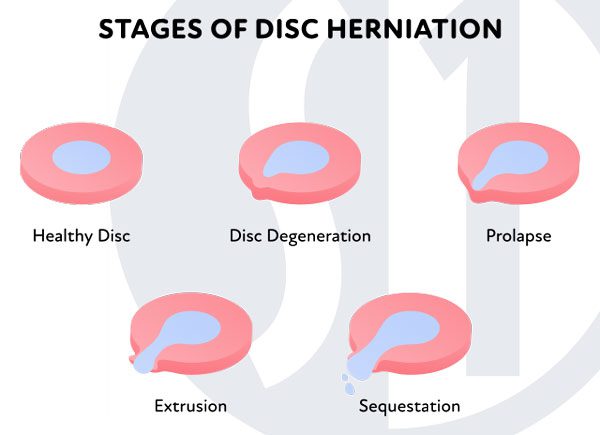 disc bulge