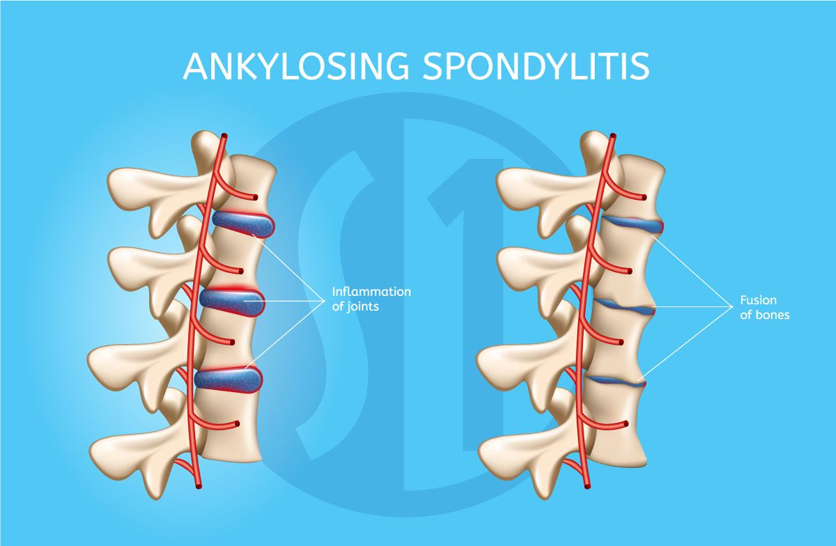 Ankylosing Spondylitis Diagram