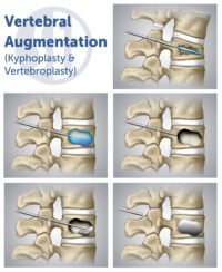 Kyphoplasty - Spine One | Denver Spine Pain Specialists