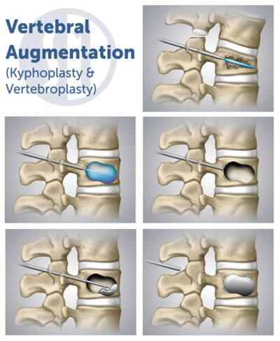 Kyphoplasty - Spine One 