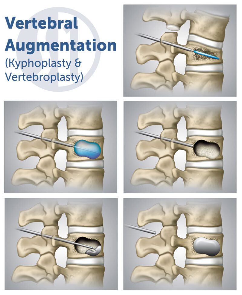 Kyphoplasty Spine One Denver Spine Pain Specialists