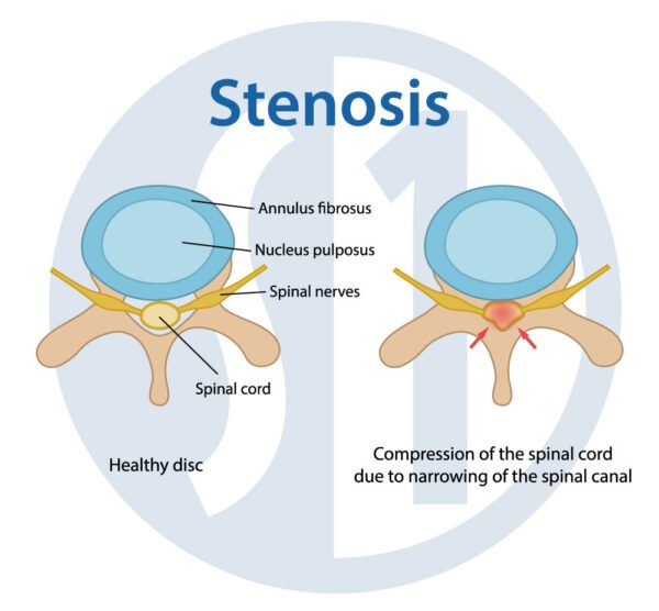 Spinal Stenosis Treatment at Spine One | Denver Spine Pain Specialists