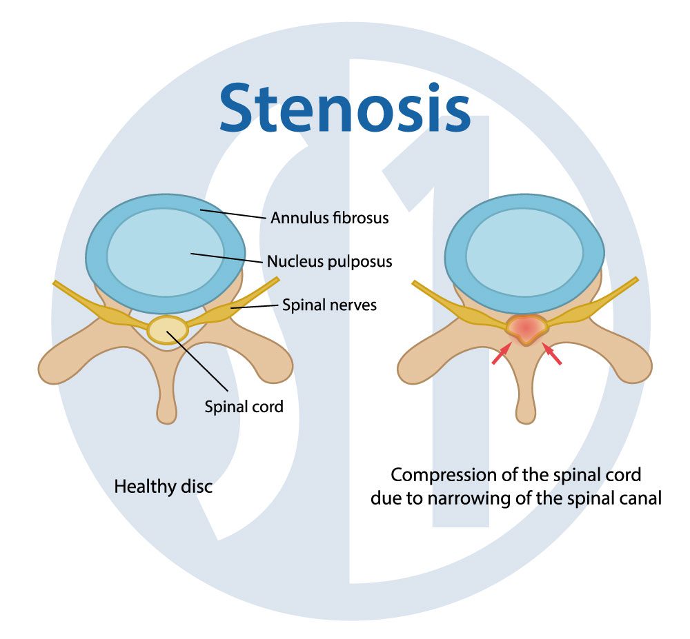 Spinal Stenosis Diagram
