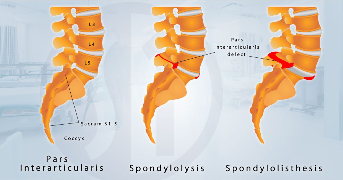 Spondylisthesis Diagram