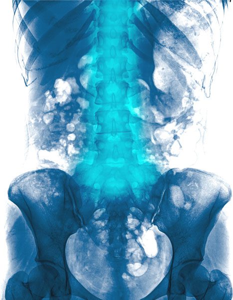 Low Back Pain Symptoms X-Ray