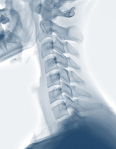 Low Back Pain Symptoms X-Ray