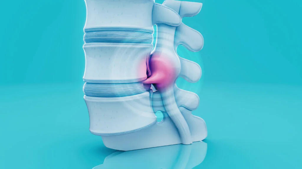 Illustration of a herniated disc on the lumbar spine