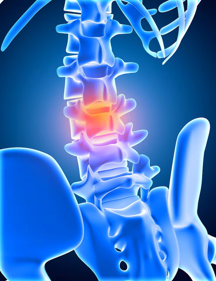 Infographic of a blue spine with pain highlighted in red
