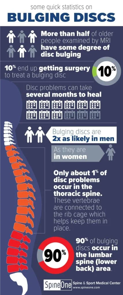 Infographic on bulging discs