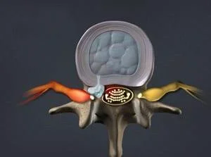 Illustration of a spine condition