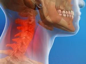 Illustration of a neck pain condition