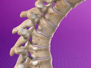 Illustration of spinal kyphosis condition