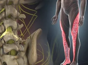 Illustration of a back and legs representing sciatica